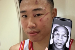 贺希宁晒脸部伤痕对比拳王泰森：如果这是赢球的代价 我愿意🔥