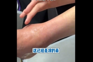 还没好又崴了！沈梓捷：和上次崴的同一只脚 没上次严重就是肿痛